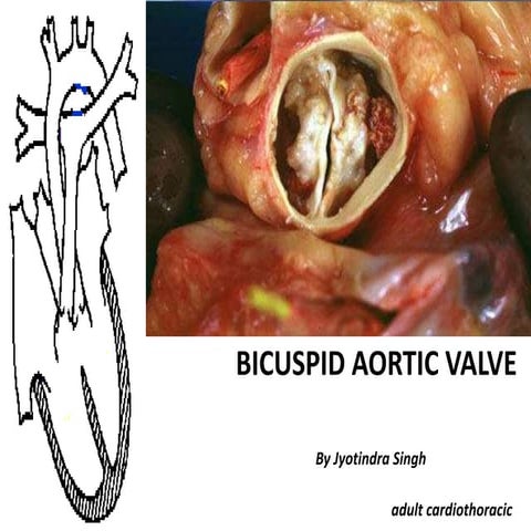 Bicuspid aortic valve