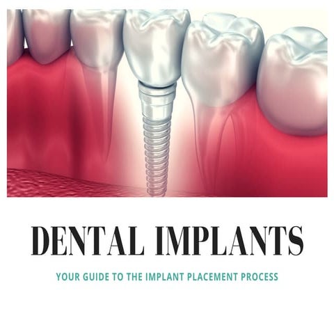 Dental Implants: Your Guide to the Implant Placement Process | PDF