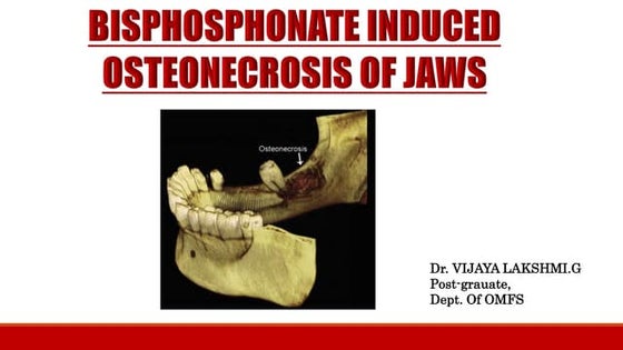Osteonecrosis of the Jaws (BRONJ, MRONJ) | PPT
