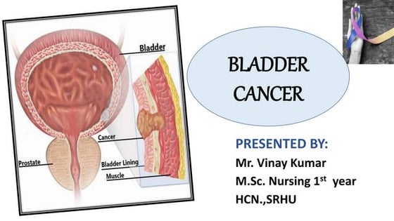 Bladder cancer.pptx