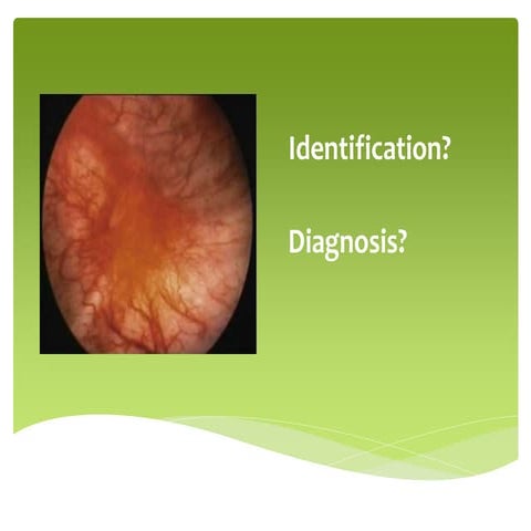 Bladder pain syndrome / Interstitial Cystitis