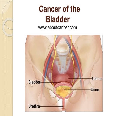 Cancer of the Bladder