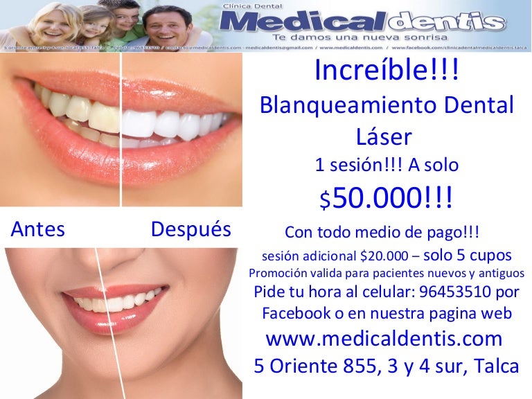 Promocion Dental Laser Blanqueamiento Agosto 2014