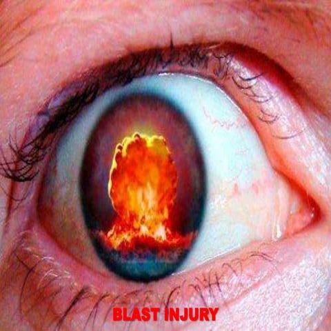 Blast injuries