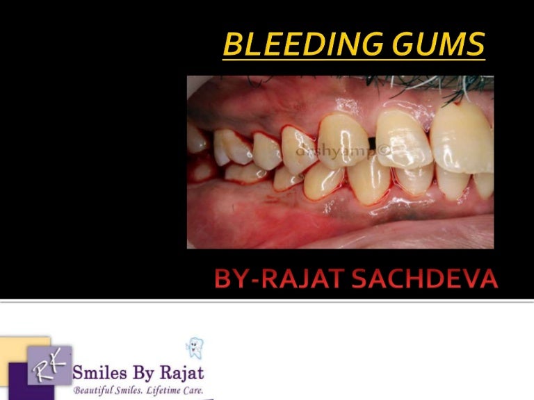 Bleeding Gums Periodontal Treatment Delhi