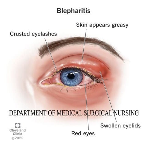 blepharitis                        .pptx