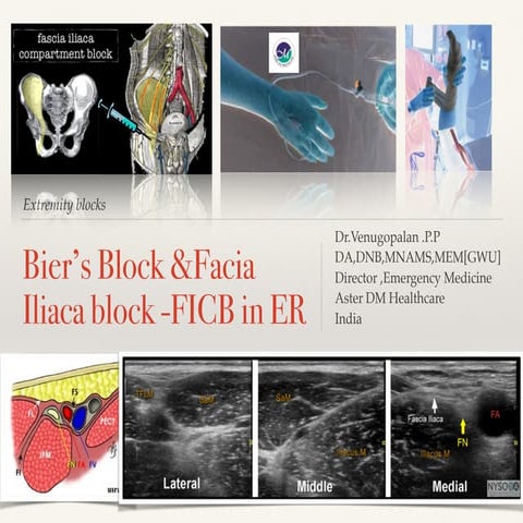 Fascia Iliaca and Biers blocks in Emergency room