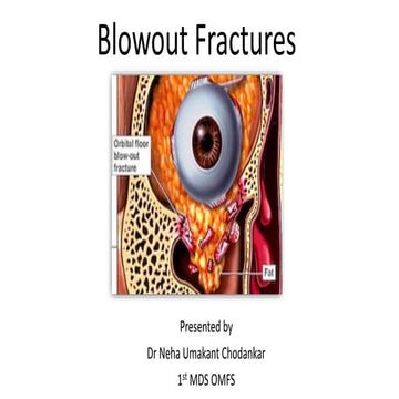 Blowout  fractures.pptx