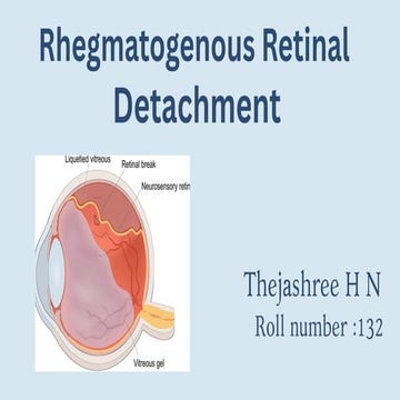 RETINOSCHISIS AND RETINAL DETACHMENT | PPT