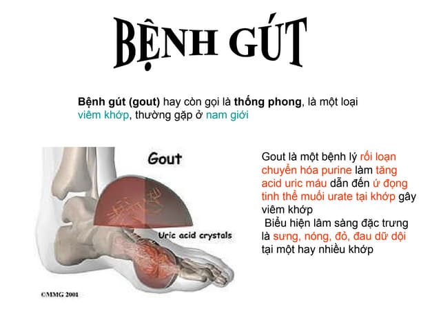 Bênh gút