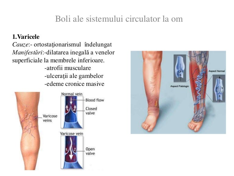 Boli ale sistemlui circulator la om