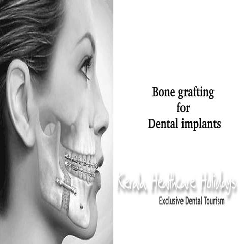 Bone grafts for dental implants