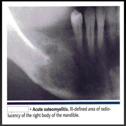 Bone infection dina patho | PPT