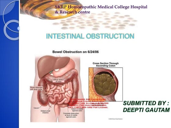Intestinal obstruction with Nursing Management | PPT