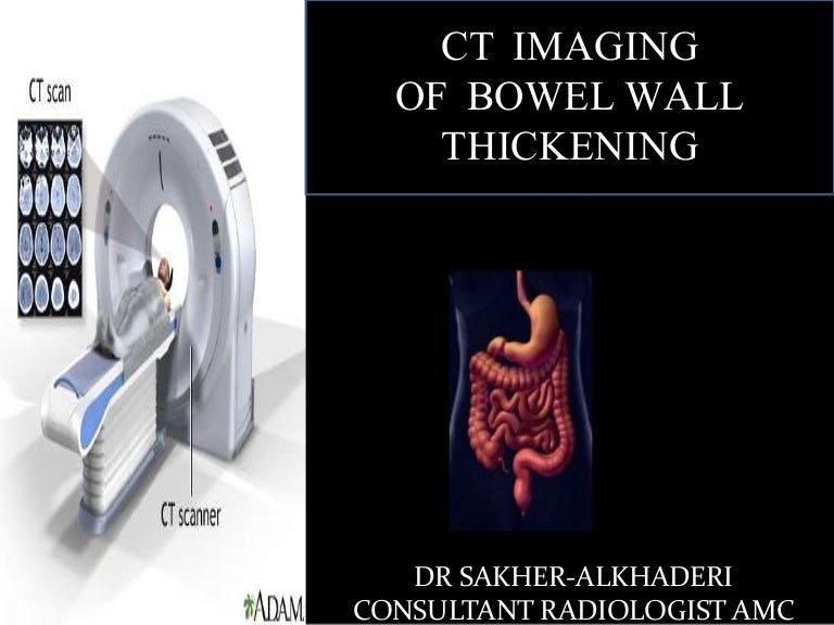 CT Imaging of Bowel Wall Thickening