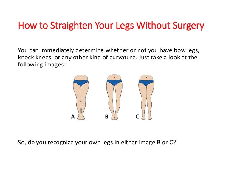 How To Straighten Legs Knock Knees Without Surgery