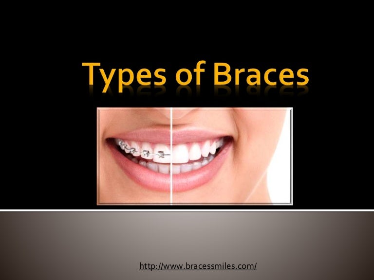 Types of Braces by Braces & Smiles Orthodontic and Dental Care Dentis…