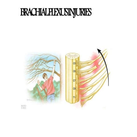 Brachial plexus injuries