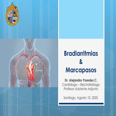 Bradiarritmias y Marcapasos