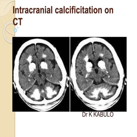 intracerebral calcification