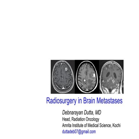 Radiosurgery in Brain Metastases  