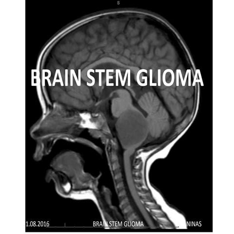 Brain stem glioma