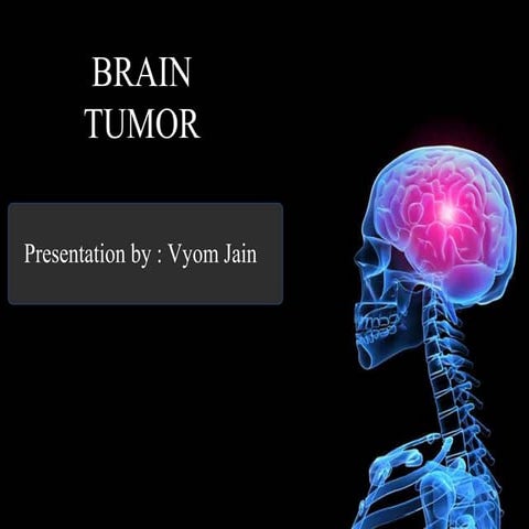Brain tumor | PPT
