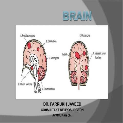 Brain tumors for Undergraduate Students