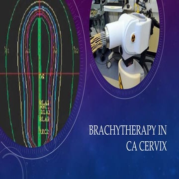 Brachytherapy in Carcinoma Cervix 