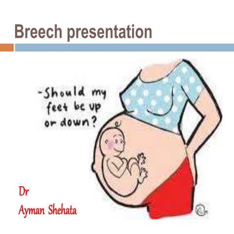 Breech presentation
