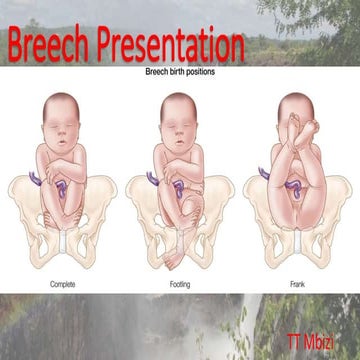 Breech presentation, types and its management | PPTX