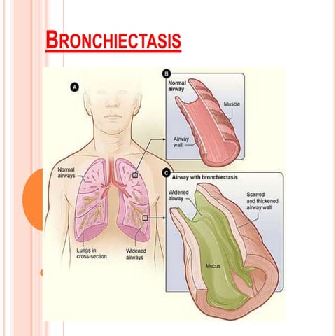:Bronchiectasis :  Nursing Management