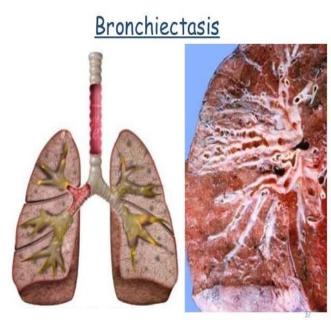 Bronchiectasis 