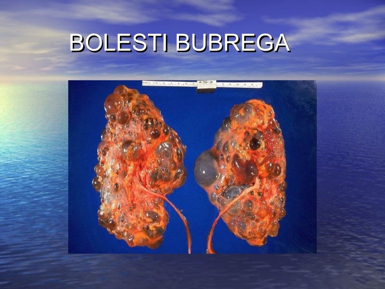 BOLESTI BUBREGA