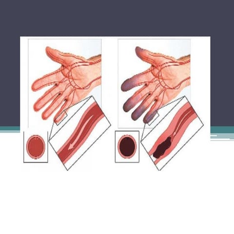 Buerger's  disease  ( Thromboangiitis obliterans)