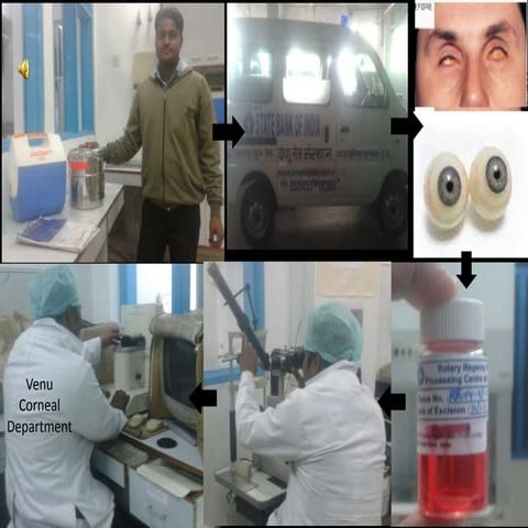 Penetrating keratoplasty by pushkar dhir