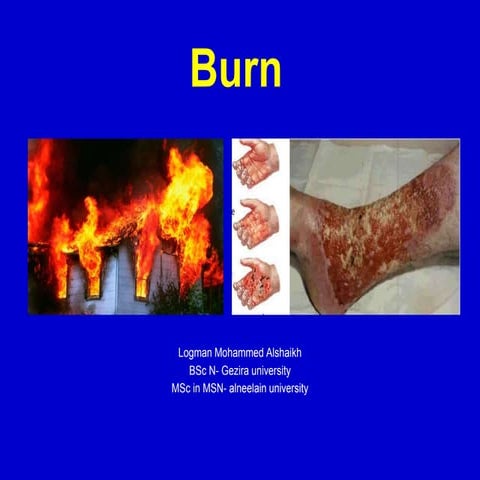 Burn