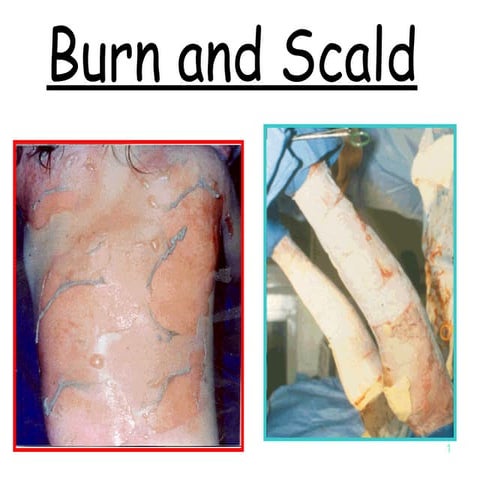Burn And  Scald