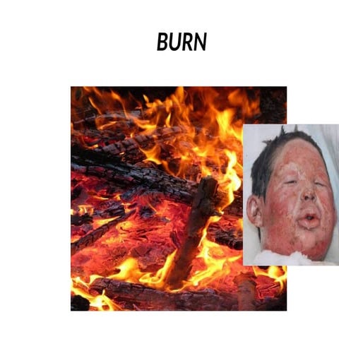 Burn | PPTX