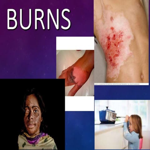 Burns in detail