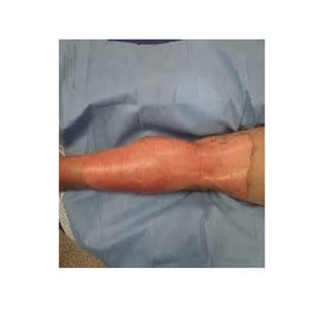 BURNS.pptx, comprehensive images of all burns