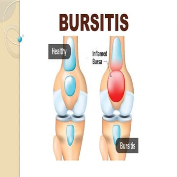 Bursitis, Causes, Pathophysiology, CM, Management.pptx