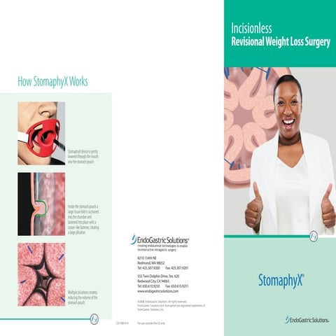 Esophyx Physician Brochure | PDF