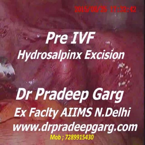 Hydrosalpinx Excision ; Pre IVF; Dr Pradeep Garg