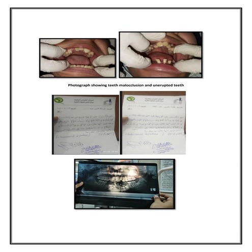 Cleidocranial Dysplasia (Dysostosis).pdf