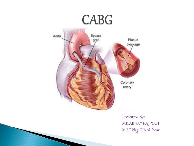 Cabg