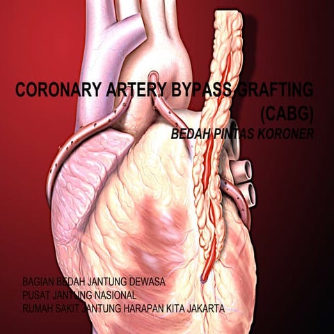 Cabg awam | PPT