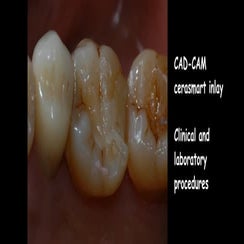 CAD-CAM inlay made by Aadva lab scanner and Cerasmart Block | PPT