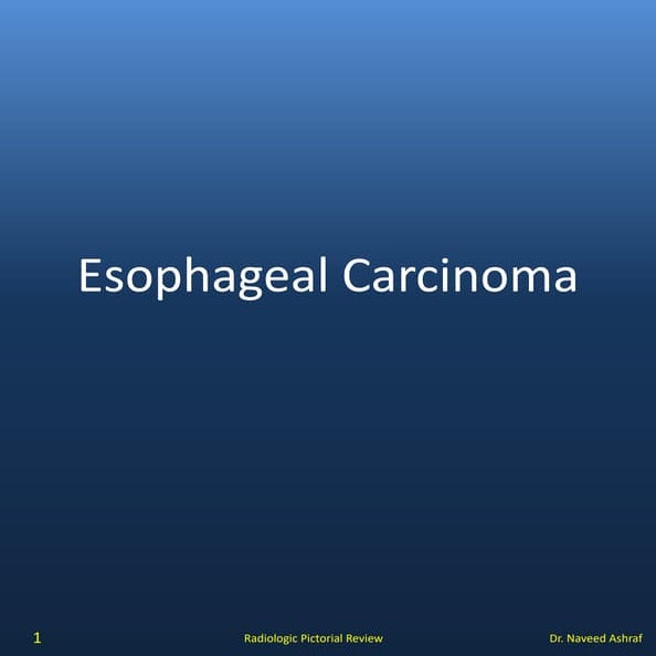 Carcinoma of  Esophagus