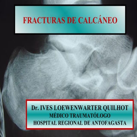 Técnica de calcaneo stop vs endortesis en el pie plano infantil | PDF
